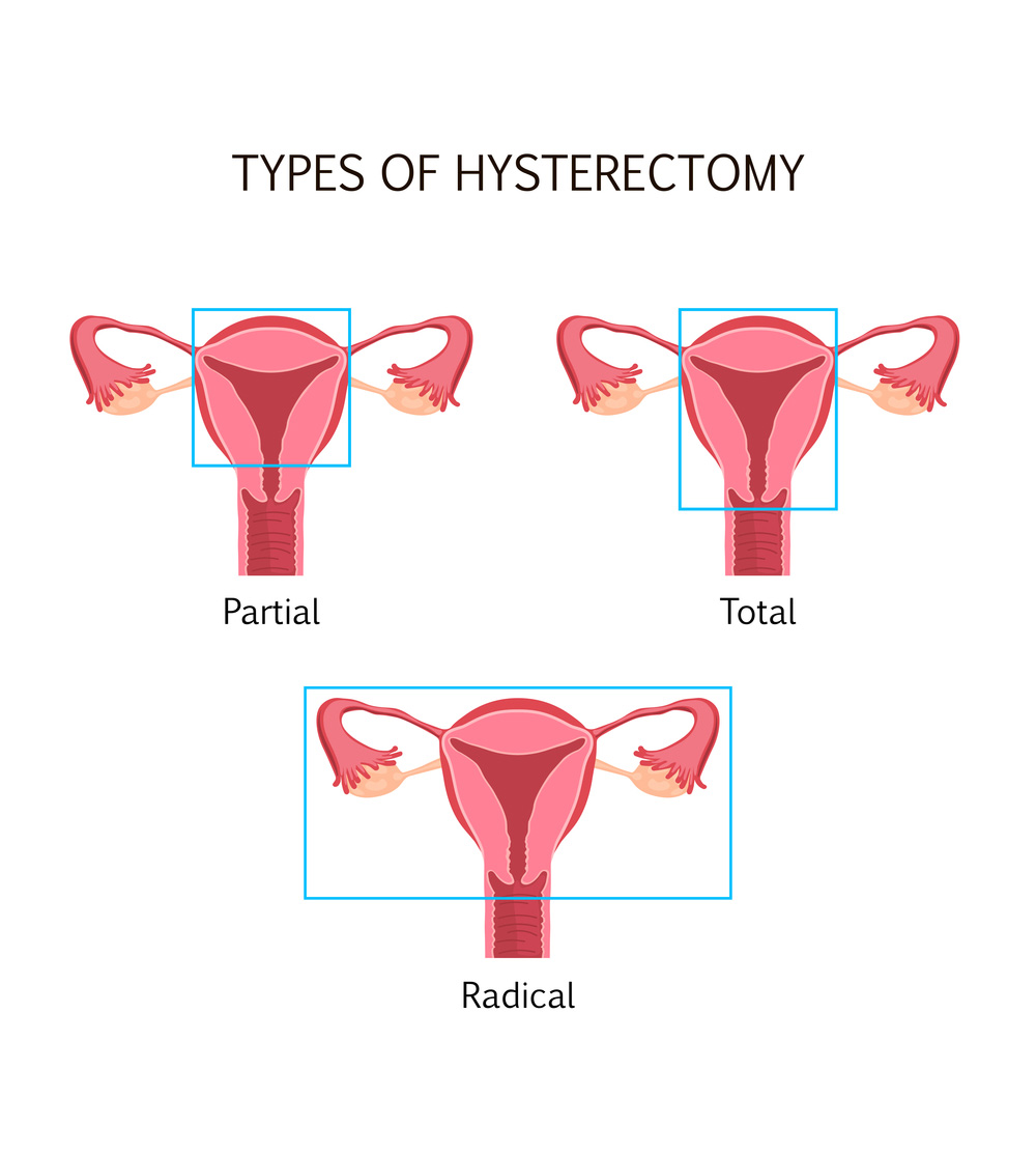 Hysterectomy » Hegde Hospital