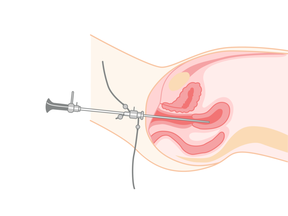 Hysteroscopy surgery